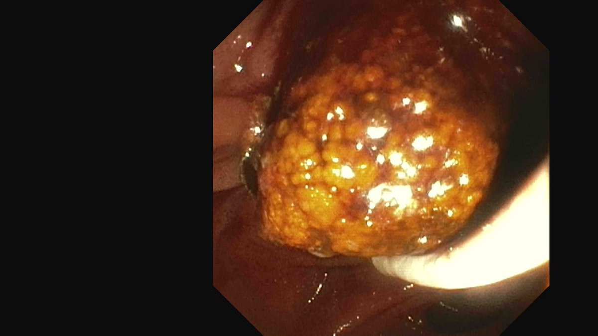 DouglasAdlerMD's tweet image. Don't be afraid to EXTEND a prior sphincterotomy if you feel it is inadequate. 

This pt had a 25mm stone and a decent prior sphincterotomy. Extended and completed and stone removed with a balloon sweep during ERCP. 

#gitwitter #surgery #medx #medtwitter