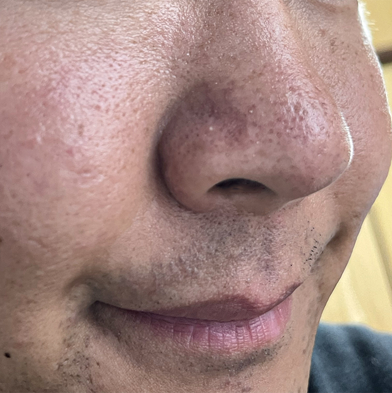 no___a07's tweet photo. おじさんのこういう毛穴って「過剰皮脂・髭剃りダメージ、乾燥」とか複合的な原因から来てるけど、これ使えば過剰皮脂抑えて潤い補給、ヨモギが鎮静するからガチで毛穴なくなる。強力な抗酸化効果でめちゃくちゃ肌が若返る。 https://t.co/C8IAStWjVg