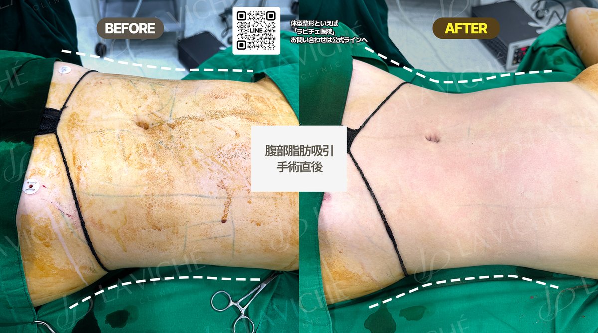 ラビチェ医院【脂肪吸引・脂肪吸入・脂肪移植・豊胸・脂肪豊胸・二重顎・二の腕・腹部・太もも・全身】 tweet media