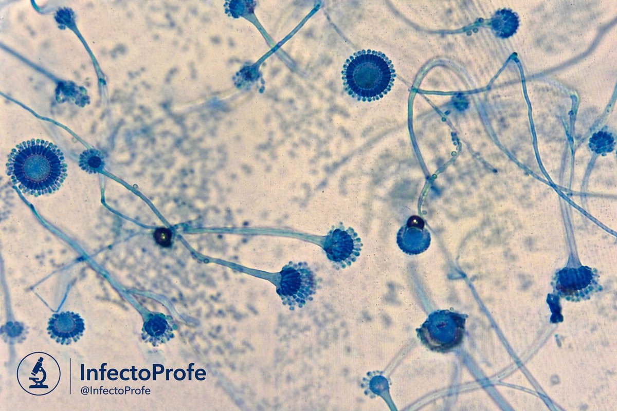 InfectoProfe's tweet photo. #casoclínico
TMO + esteroides
Fiebre, tos seca, disnea
TAC: halo sign
LBA 👇 (imagen)

❓¿Todos los Aspergillus se ven iguales?

#InfectiousDiseases #Microbiology #Aspergillus #Antifungal #IDTwitter https://t.co/gyPNVu7S8m
