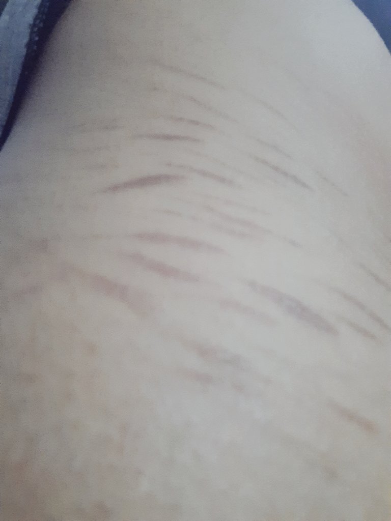 licoricxokegom's tweet photo. Cicatrices de styros creo les dicen, no se, pero amo amo estas cicatrices

El primero quien adivine en k zona en la que se encuentran mis cicatrices me rajo su inicial 

#shtwt https://t.co/yRTi7M7U02