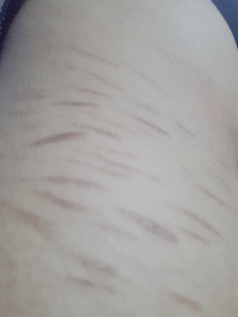 licoricxokegom's tweet photo. Cicatrices de styros creo les dicen, no se, pero amo amo estas cicatrices

El primero quien adivine en k zona en la que se encuentran mis cicatrices me rajo su inicial 

#shtwt https://t.co/yRTi7M7U02