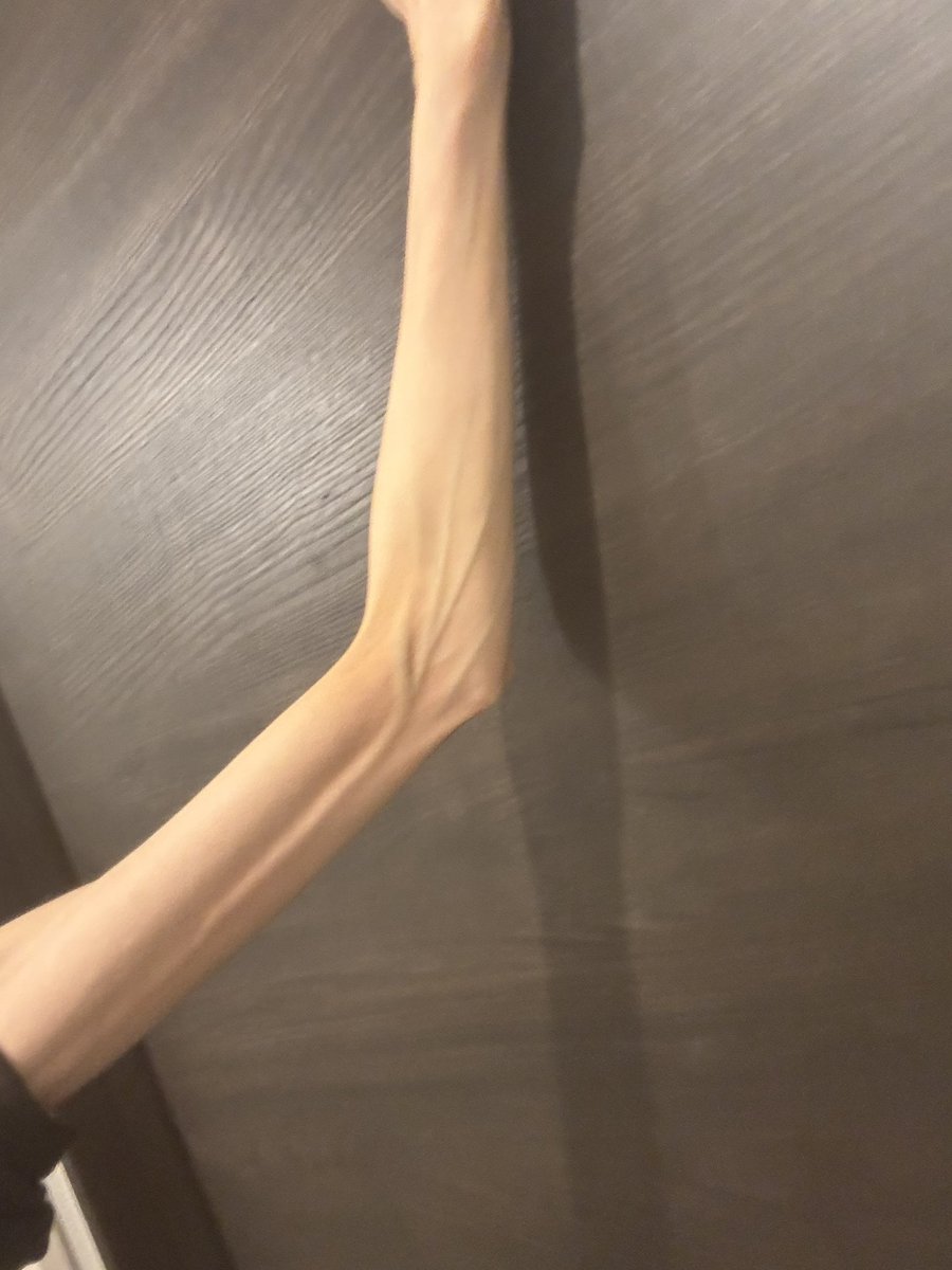 Oimo__ice10's tweet image. 親に骨と皮。鳥の足のよう。
言われ慣れた^^醜いのは自分が1番分かっている。本当は自分の好きな物食べて健康になっていきたいけどお金ないから今日もラコール半分頑張って飲む、、生きてる自分偉い。
#edtwt #ed #thinspo #ana #bonespo 
#拒食症 #摂食障害 #摂食障害克服中
#闘病垢さんと繋がりたい