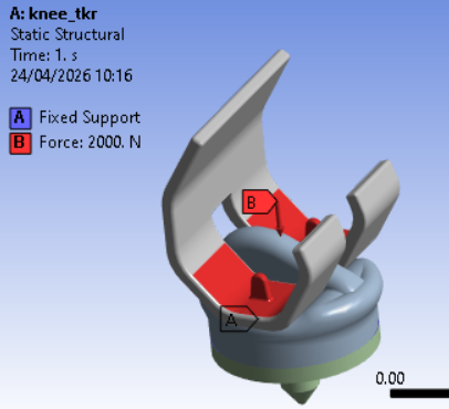 affanned399's tweet image. #kneeimplant #TKR #arthroplasty #FEA #orthopedics #biomechanics #CAD #ANSYS #SolidWorks #kneeOA #jointreplacement #biomaterials #UHMWPE #3Dprinting #medtech #biomedicalengineering #finiteelementanalysis #posteriorstabilized #jointdesign #rRuskin #Anglia #Dissertation #Mechanical