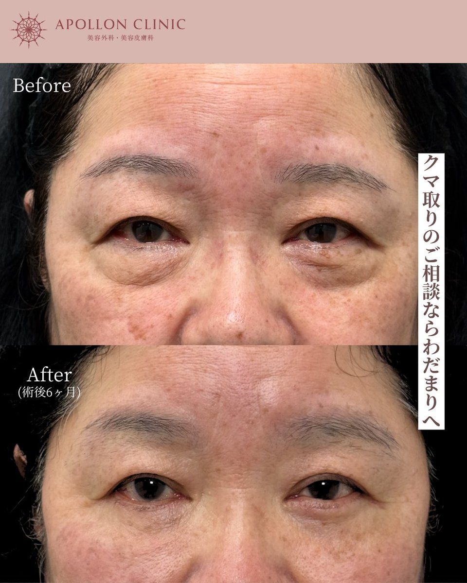 ApollonClinic's tweet photo. 目の下のたるみを治療する「切開ハムラ法」
一気に若々しい印象になれる施術です✨
クマ取りのご相談はわだまりへ！ https://t.co/t9ALCf5hrs