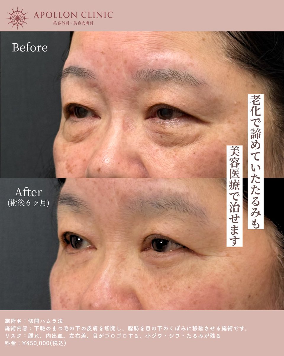 ApollonClinic's tweet photo. 目の下のたるみを治療する「切開ハムラ法」
一気に若々しい印象になれる施術です✨
クマ取りのご相談はわだまりへ！ https://t.co/t9ALCf5hrs