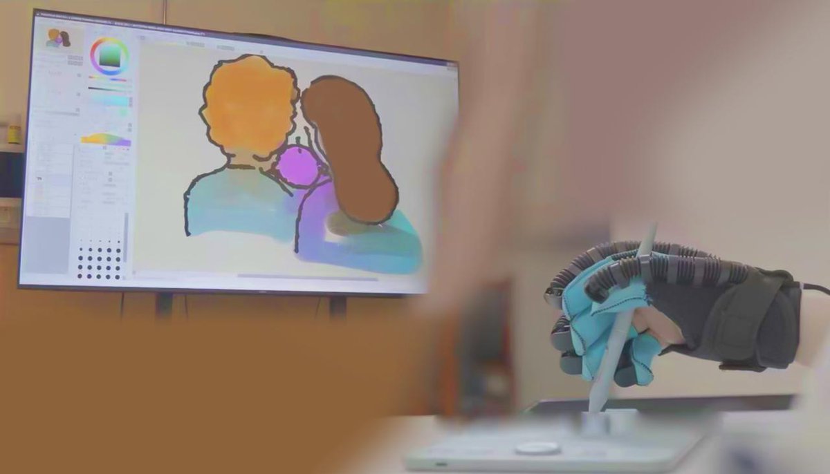 A Chinese neurosurgery team recently successfully performed a clinical implantation of a fully implantable, fully wireless, fully functional ("Triple-F") brain-computer interface (BCI) system in Nanchang, east China's Jiangxi Province. 

The "Triple-F" system employs a flexible