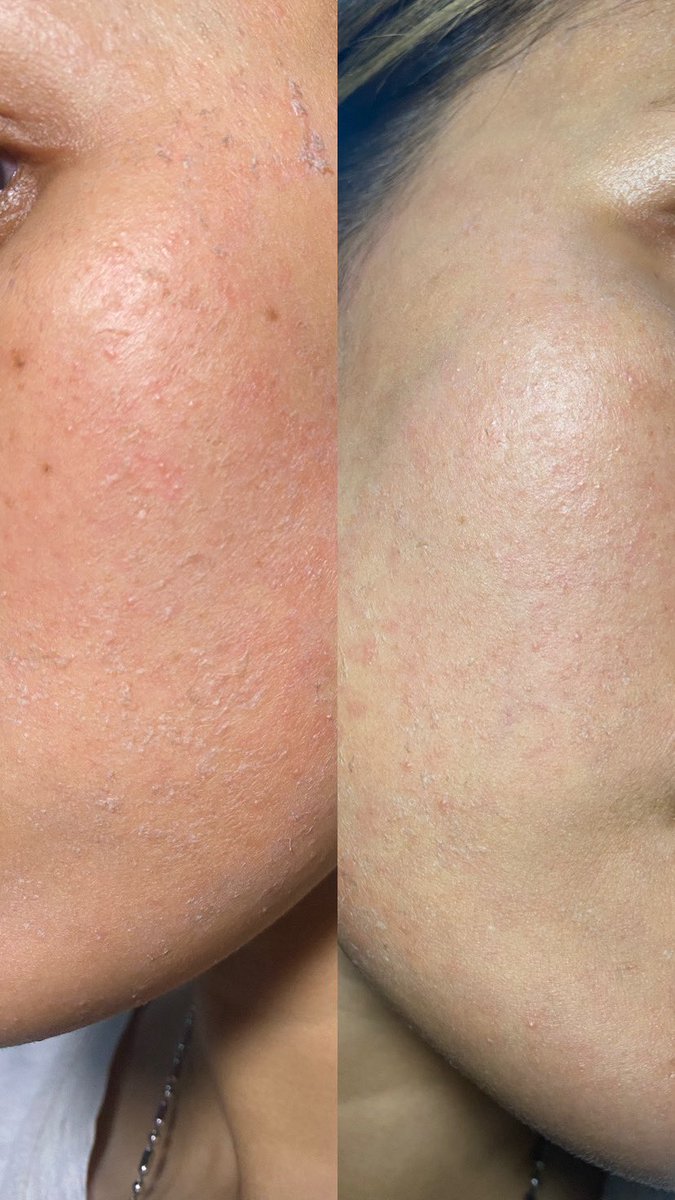 apasidy_'s tweet photo. ini dermatitis! bukan jerawat atau kemerahan biasa
beda penyakit beda juga penanganannya

kalo kamu kaya gini dan rasanya panas, perih, kering dann gatelnyaa naudzubillahhhh
bisa jadi kamu dermatitis. cepet priksain ke drSpkk dan jangan self diagnosis

karna aku dermatitis seboroik, jadi ada pengerakan ketombe di kulit kepala