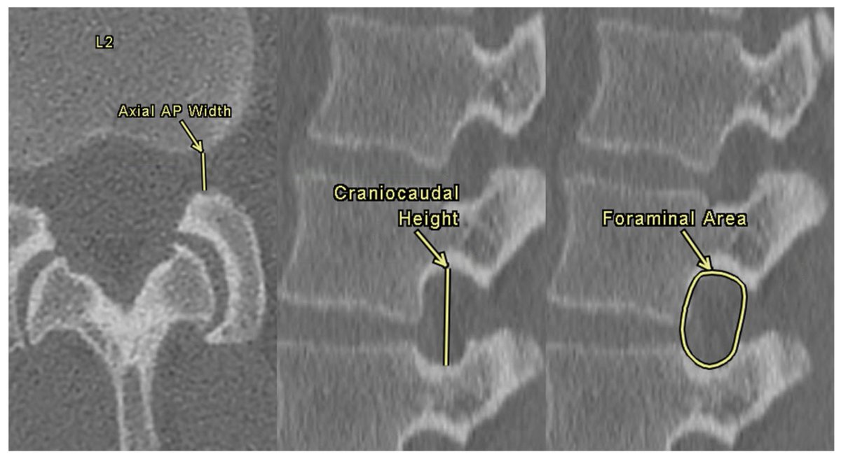 Tomography_MDPI's tweet image. 🔎📑 Our publication in Tomography explores how lumbar spine anatomy connects—interspinous distance, disc height, and neuroforaminal dimensions.

➡️ brnw.ch/21x1TH9

#Radiology #MedicalImaging #OrthopaedicRadiology #LumbarSpine #DiscSpace #ComputedTomography