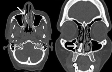 RevMedInterne's tweet photo. 📸Image
Patient de 30 ans, sans antécédent, consultant pour rhinorrhée purulente et obstruction nasale droite. A l'examen vous noter une masse dure, grisâtre, adhérente au méat moyen. Quel est votre diagnostic ? 
La réponse dans la publication original : https://t.co/lhY3NyX5z1 https://t.co/Y61wUG1pbL