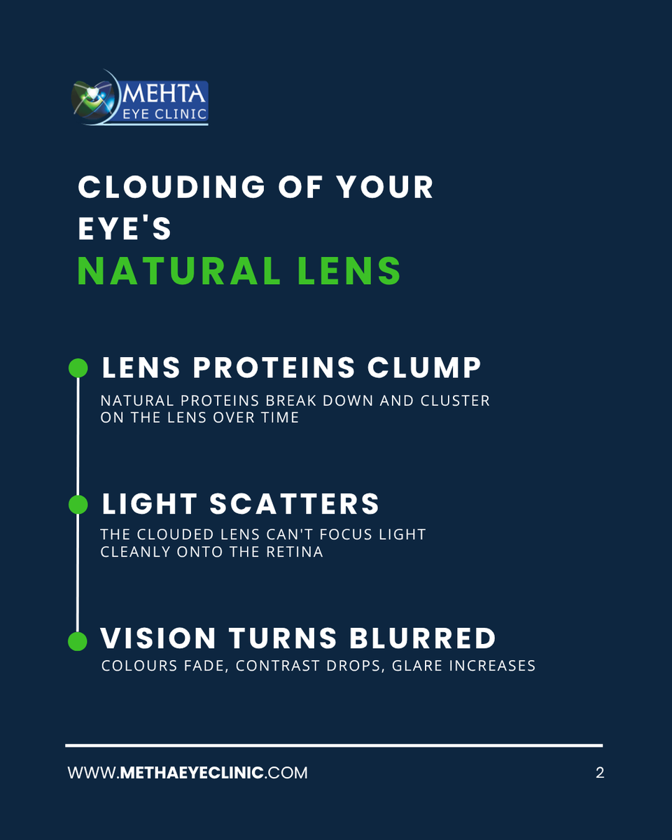 MehtaEyeClinic's tweet image. Cataracts develop gradually and can affect daily vision over time.

A simple eye examination can help detect and manage it effectively.

#Cataract #EyeHealth #VisionCare #MehtaEyeClinic