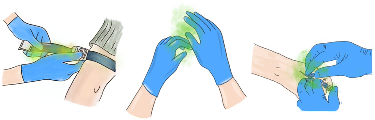 Micro_MDPI's tweet image. Reusable medical devices = overlooked infection risk? 🏥🦠

This study reveals significant bacterial contamination on tourniquets:
🔬 Up to 545 CFU/cm² in emergency settings
⚠️ Higher loads vs operating theatre

👉 mdpi.com/2076-2607/13/1…
#HAIs #InfectionControl #PatientSafety