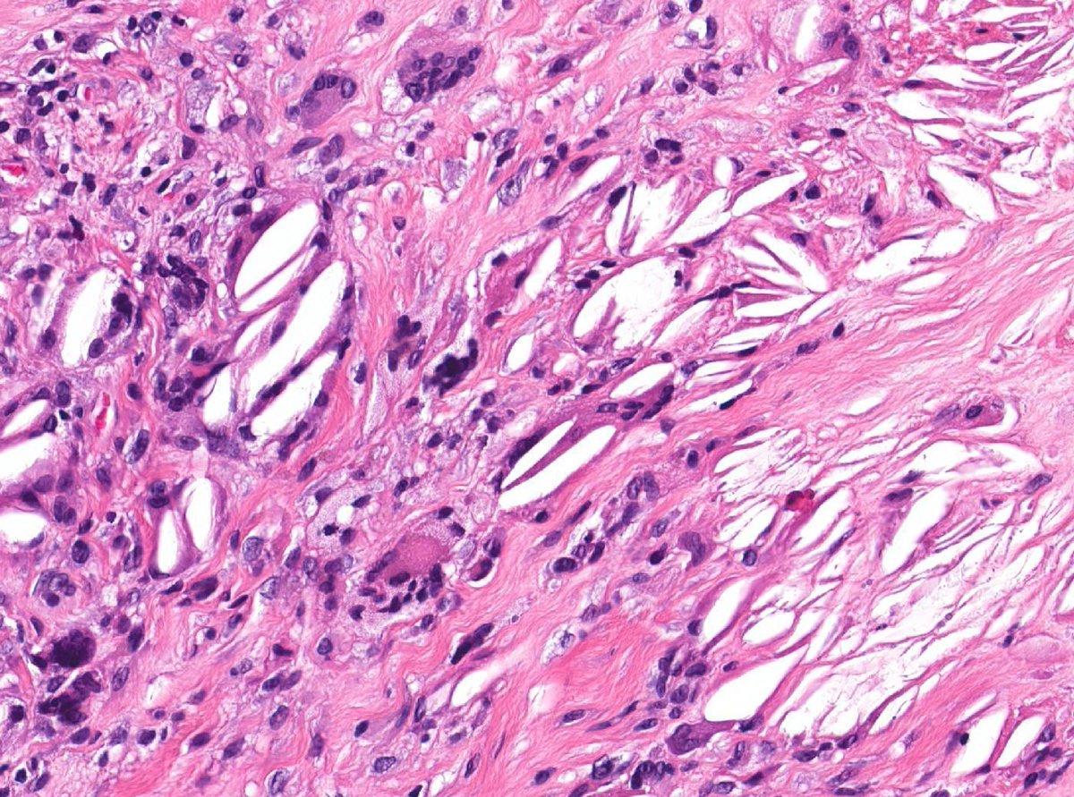 JMGardnerMD's tweet image. Elderly adult with indurated yellowish skin plaques around eyes and on neck and trunk.
What is the diagnosis?
What systemic disease might they have? 
Answers ✅  youtu.be/s2fQ80Wb7xI 
#pathology #pathologists #pathTwitter #dermpath #dermatology #dermatologia #dermtwitter