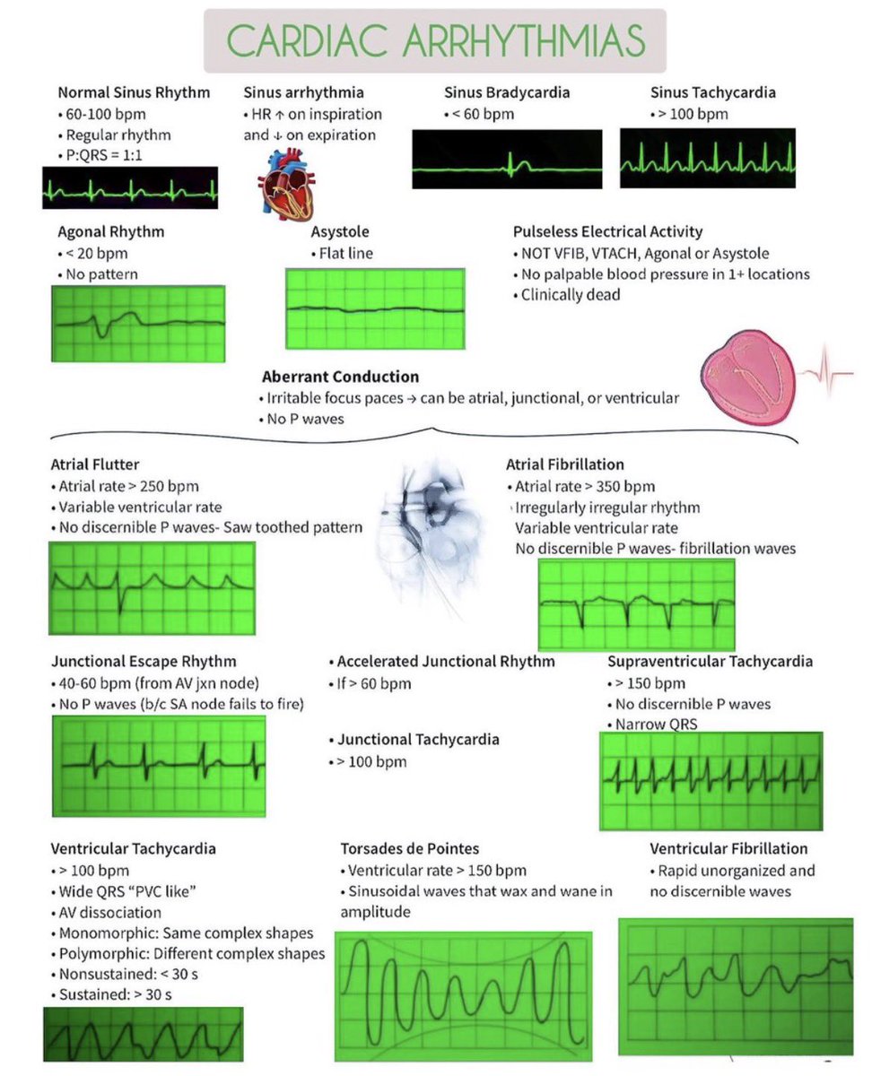 Cardiac arrhythmias vary widely in rhythm, rate, and morphology. Quick ...