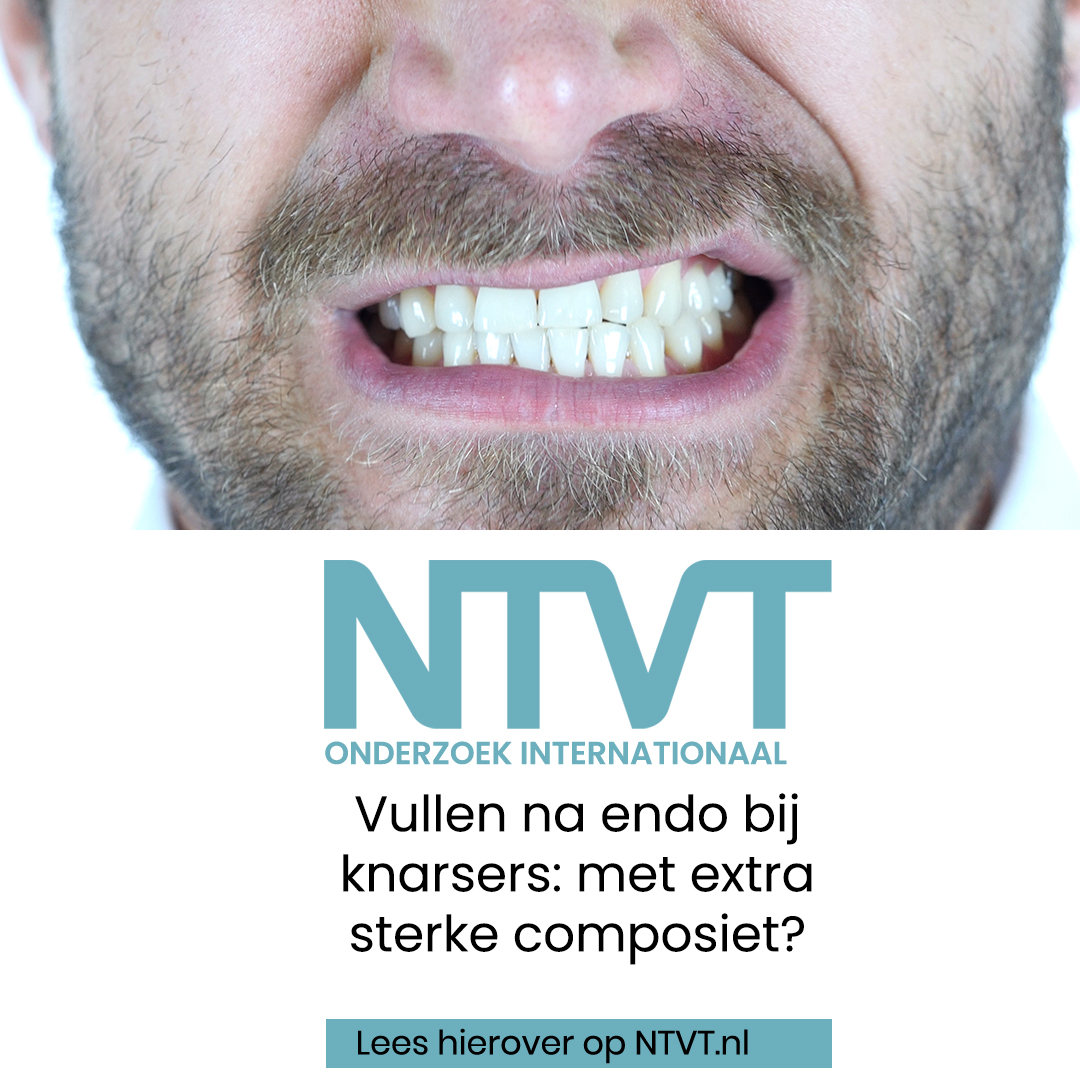 Na een wortelkanaalbehandeling bij bruxisme kan gerust een jaar lang een directe adhesieve composietrestauratie worden toegepast voor al dan niet indirect restaureren, ongeacht of het een ‘gewone’ of glasvezelversterkte composiet is. 

Lees meer: ntvt.nl/onderzoek/onde…