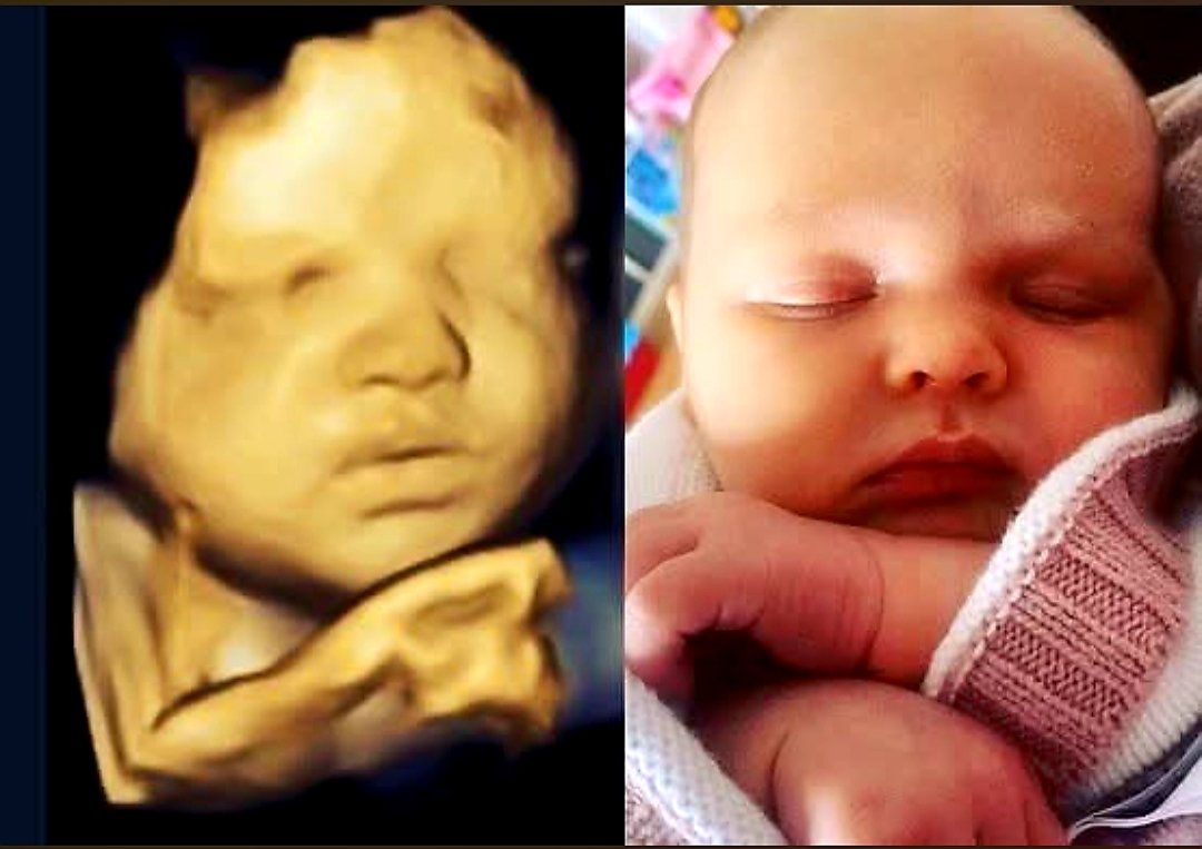 ProLifeBrother's tweet image. Before &amp;amp; After. 
#ProLife #ProLifeGen #ChooseLife