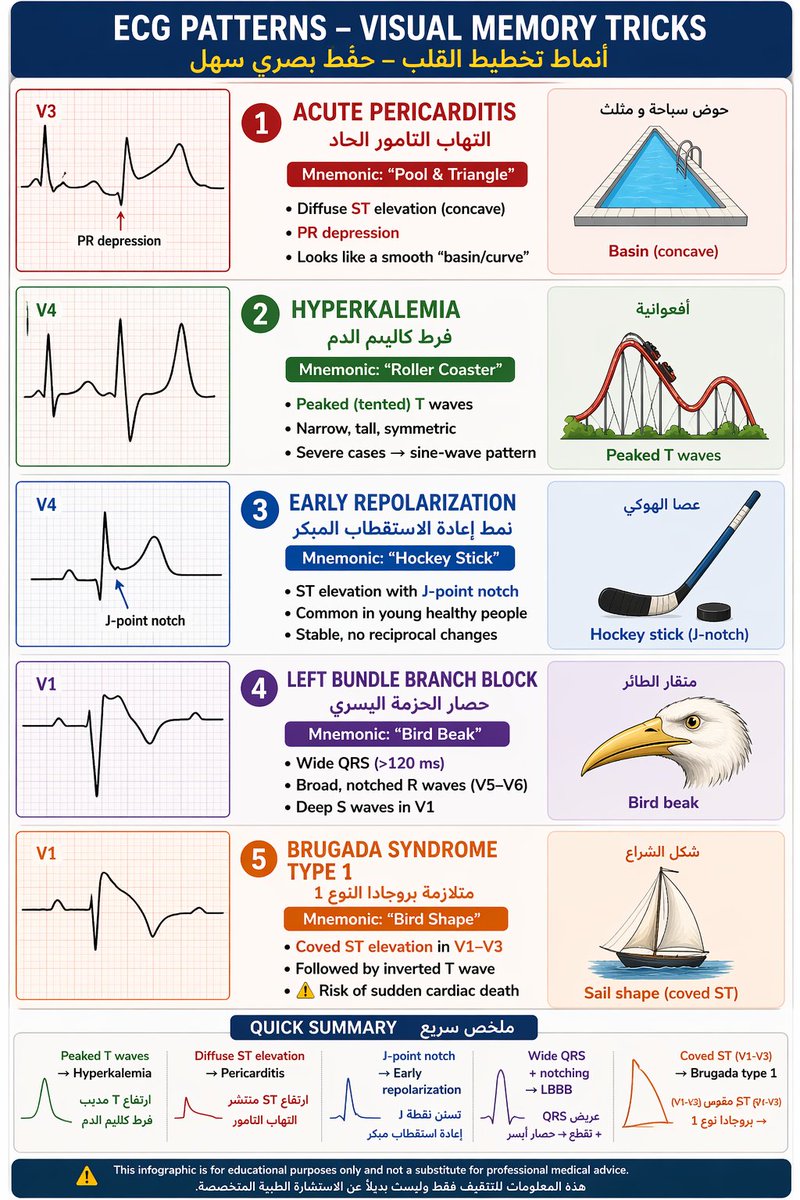 🫀 ECG Patterns – Visual Memory Tricks 🔺 Acute Pericarditis Mnemonic ...