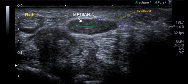 Phalen test evaluates for carpal tunnel syndrome. The patient places both wrists in maximal flexion with the dorsal surfaces of the hands pressed together in a “reverse prayer” position, actively applying pressure and maintains this posture for 30–60 seconds. This maneuver