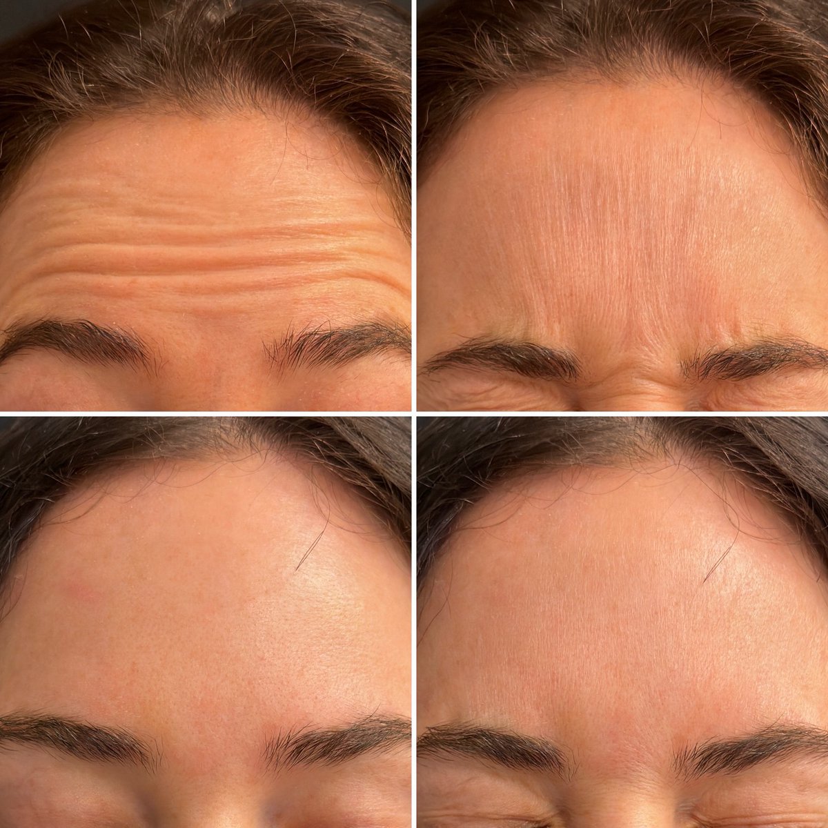 lucky_9960's tweet image. Botox is doing "God's work" 🙌🏻

#Botox #Wrinkles #InjectionNurse #AestheticMedicine