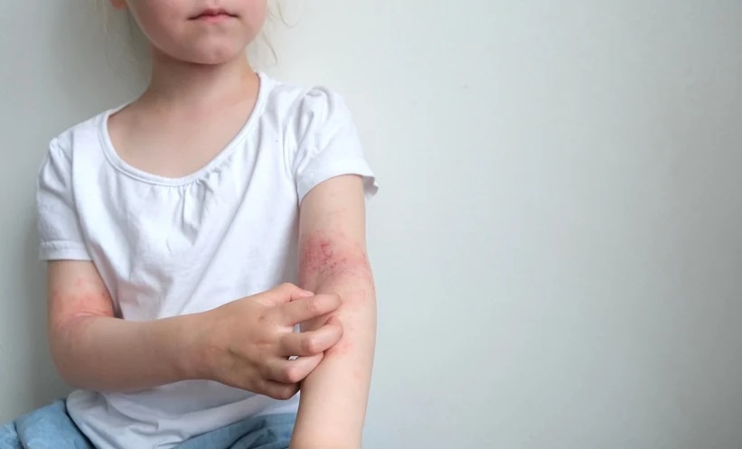 Aller_MD's tweet photo. #Asthma risk in children with early-onset #atopic #dermatitis (#AD) was significantly elevated, according to a large population-based study analysing nationwide data from South Korea. https://t.co/DRYwXfZ9j5 https://t.co/ASH6g4aco4