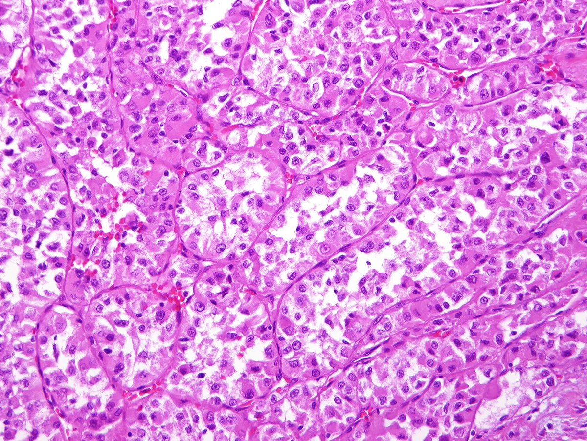 DrCycloPath's tweet image. #PathQuiz 🔬🧬 #SoftTissuePath

A) Alveolar Rhabdomyosarcoma
B) Clear Cell Sarcoma
C) Epithelioid Sarcoma
D) Alveolar Soft Part Sarcoma

#Pathology #SoftTissuePath #Sarcoma