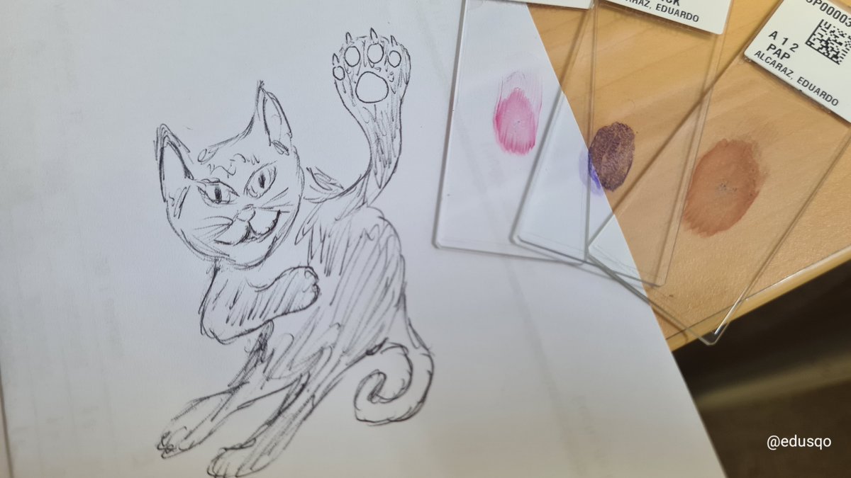 edusqo's tweet image. Cat scratch 🐱 disease for this #FNAFriday:
▫️Self-limited (Bartonella)
▫️Lymph node involvement
▫️Neutrophils, necrosis, granulomas and tingible body macrophages
▫️It resolves in 1-4 months 
▫️Fine Needle Aspiration rules out malignancy
▫️Serology for def Dx
#HemePath #CytoPath