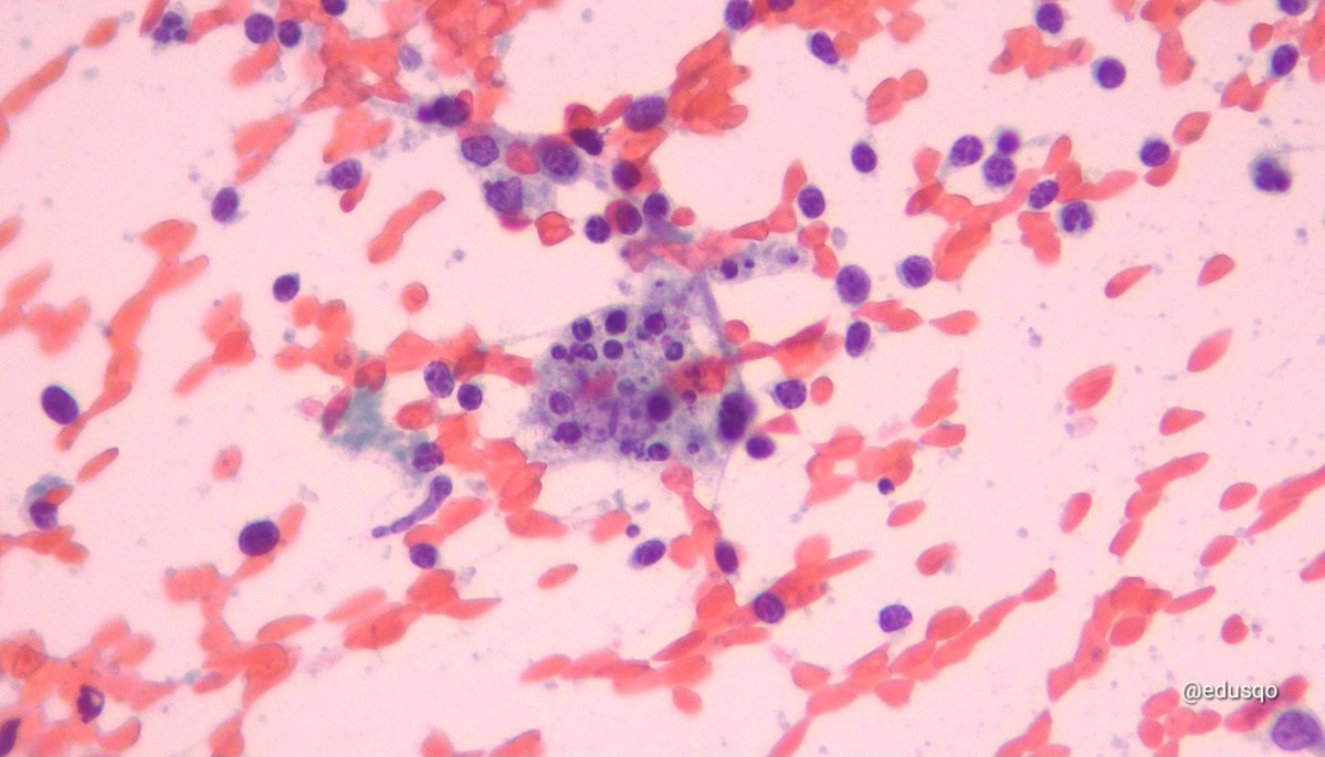 edusqo's tweet image. Cat scratch 🐱 disease for this #FNAFriday:
▫️Self-limited (Bartonella)
▫️Lymph node involvement
▫️Neutrophils, necrosis, granulomas and tingible body macrophages
▫️It resolves in 1-4 months 
▫️Fine Needle Aspiration rules out malignancy
▫️Serology for def Dx
#HemePath #CytoPath