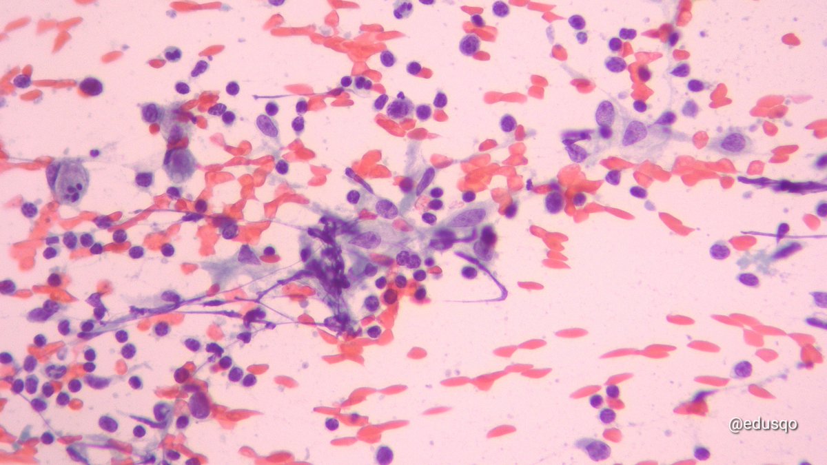 edusqo's tweet image. Cat scratch 🐱 disease for this #FNAFriday:
▫️Self-limited (Bartonella)
▫️Lymph node involvement
▫️Neutrophils, necrosis, granulomas and tingible body macrophages
▫️It resolves in 1-4 months 
▫️Fine Needle Aspiration rules out malignancy
▫️Serology for def Dx
#HemePath #CytoPath