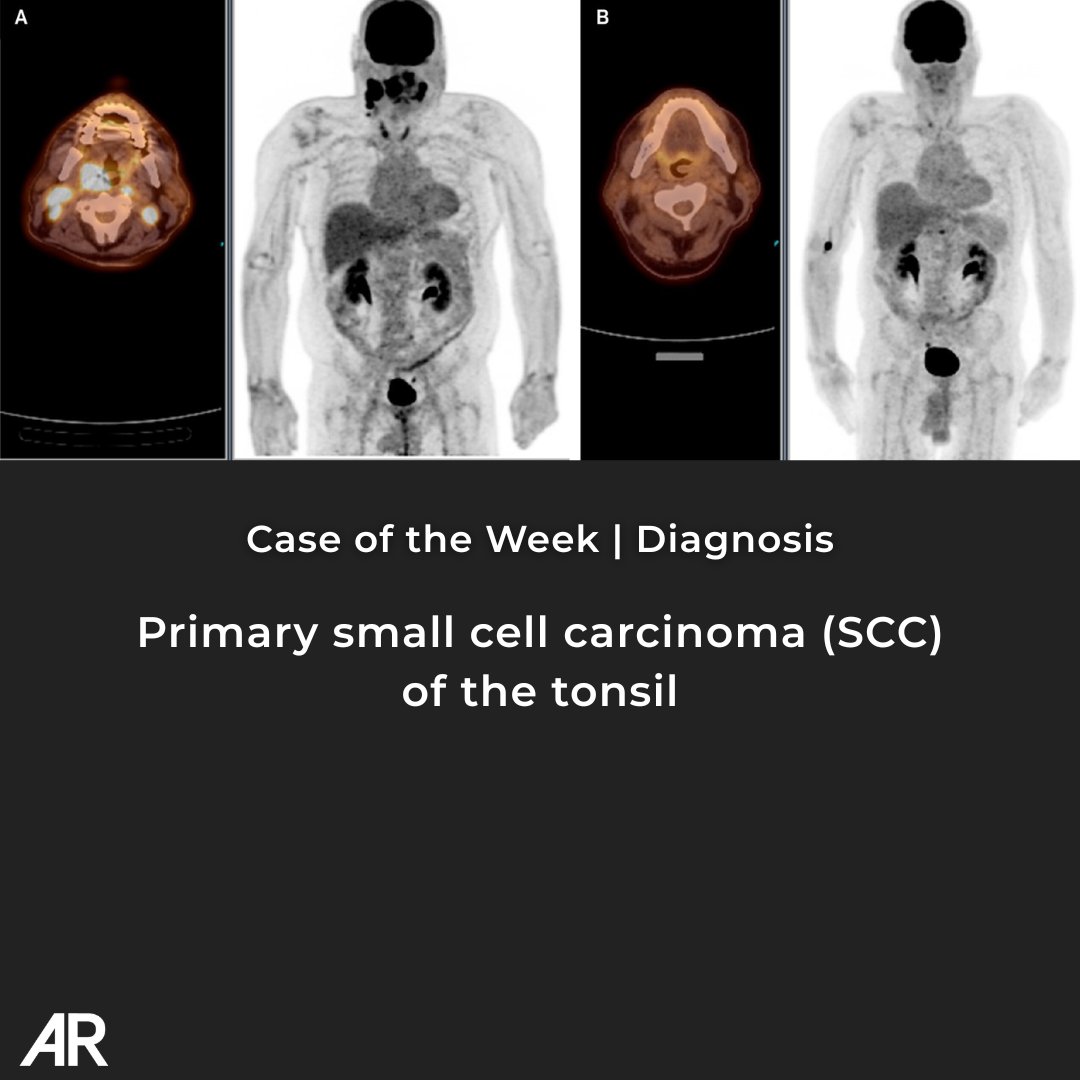 Applied_Rad's tweet image. Case Study of the Week - Diagnosis time!

Primary small cell carcinoma (SCC) of the tonsil

🔗 bit.ly/41hb1Ci 

#Radiology #RadEd #MedEd #RadiologyEducation #COW #CaseOfTheWeek