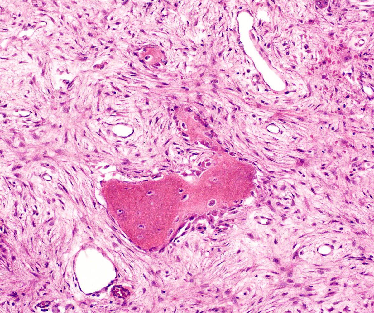 DrCycloPath's tweet image. ✅ Osteofibrous Dysplasia 🎯🦴
• Woven bone trabeculae with prominent osteoblastic rimming within a bland fibrous stroma.
• Typically epicentered in the anterior tibial cortex of children, often causing anterior bowing.
• Keratin stains highlight only isolated, single cells