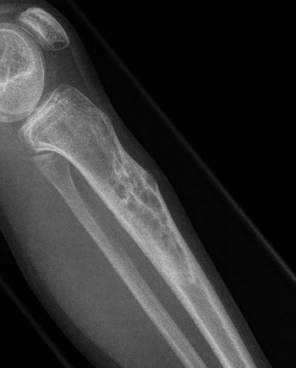 DrCycloPath's tweet image. ✅ Osteofibrous Dysplasia 🎯🦴
• Woven bone trabeculae with prominent osteoblastic rimming within a bland fibrous stroma.
• Typically epicentered in the anterior tibial cortex of children, often causing anterior bowing.
• Keratin stains highlight only isolated, single cells
