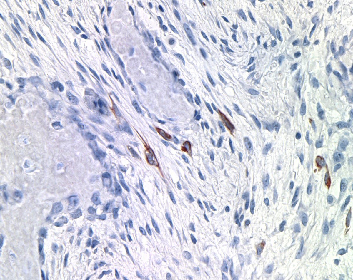 DrCycloPath's tweet image. ✅ Osteofibrous Dysplasia 🎯🦴
• Woven bone trabeculae with prominent osteoblastic rimming within a bland fibrous stroma.
• Typically epicentered in the anterior tibial cortex of children, often causing anterior bowing.
• Keratin stains highlight only isolated, single cells
