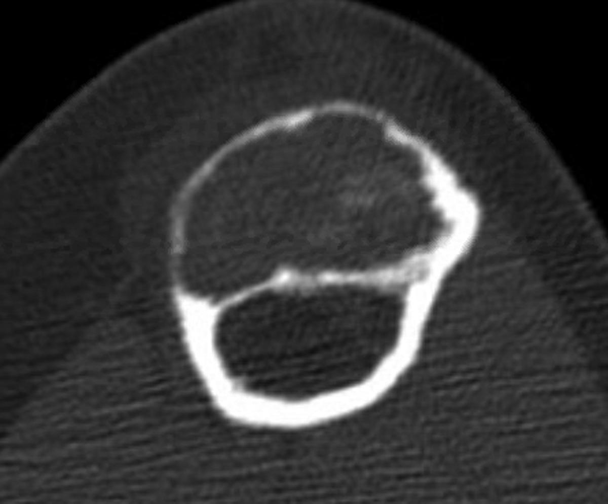 DrCycloPath's tweet image. ✅ Osteofibrous Dysplasia 🎯🦴
• Woven bone trabeculae with prominent osteoblastic rimming within a bland fibrous stroma.
• Typically epicentered in the anterior tibial cortex of children, often causing anterior bowing.
• Keratin stains highlight only isolated, single cells