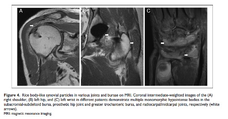 HSS_Journal's tweet photo. This retrospective study suggests that rice body-like synovial particles on MRI are not specific to tuberculosis and inflammatory arthritis. Other diagnoses may also be considered, particularly nonmycobacterial infection when there is an arthroplasty. https://t.co/XOx3hHqX4X https://t.co/GN634BVwrE