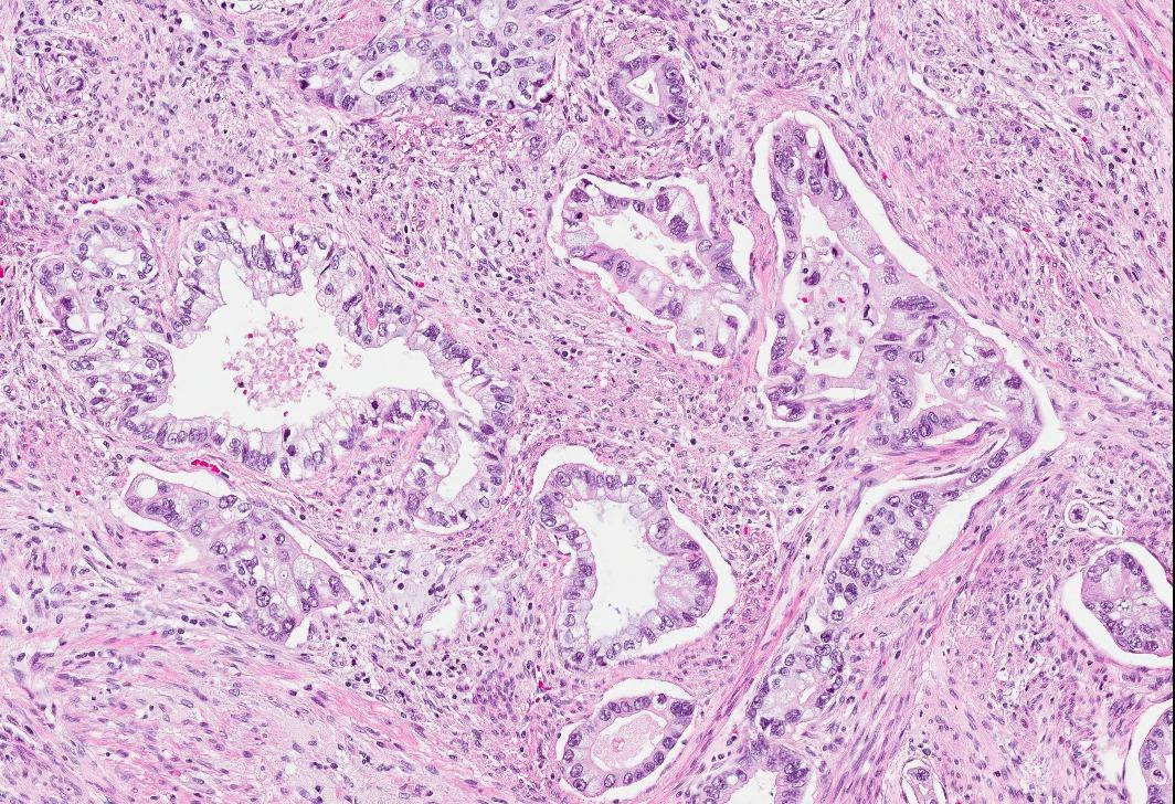 DrCycloPath's tweet image. #PathQuiz 🔬🧬 #GynPath

A) HPV-associated Adenocarcinoma
B) Clear Cell Adenocarcinoma
C) Lobular Endocervical Glandular Hyperplasia
D) Gastric-type Adenocarcinoma

#Pathology #GynPath