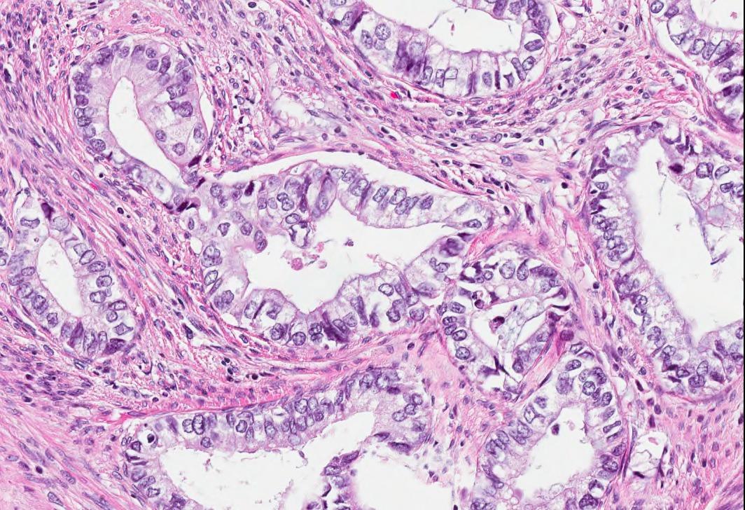 DrCycloPath's tweet photo. ✅ Gastric-type Adenocarcinoma 🎯🧬
• Aggressive HPV-independent adenocarcinoma exhibiting gastric (pyloric) differentiation.
• Glands show voluminous clear or pale eosinophilic cytoplasm, distinct cell borders, and neutral mucins.
• Frequently associated with STK11 mutations and Peutz-Jeghers syndrome, with abnormal p53 expression.
• Importantly, p16 is typically negative or patchy, distinguishing it from HPV-associated tumors.