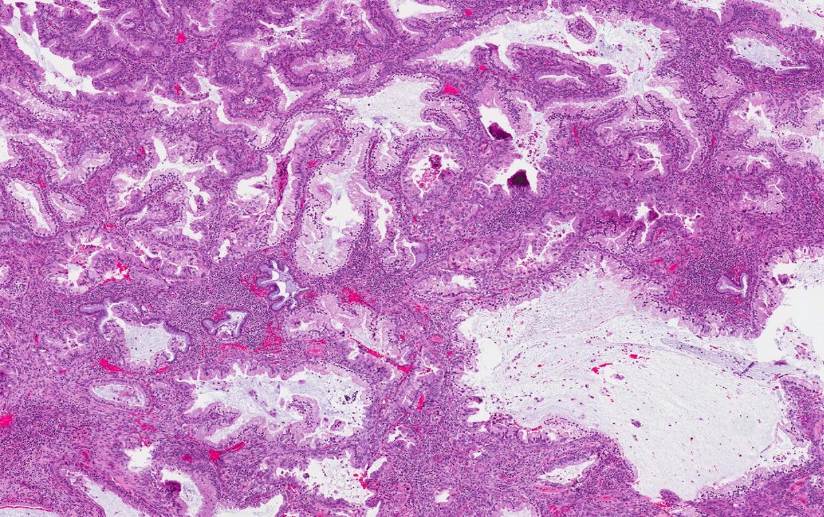 DrCycloPath's tweet photo. ✅ Gastric-type Adenocarcinoma 🎯🧬
• Aggressive HPV-independent adenocarcinoma exhibiting gastric (pyloric) differentiation.
• Glands show voluminous clear or pale eosinophilic cytoplasm, distinct cell borders, and neutral mucins.
• Frequently associated with STK11 mutations and Peutz-Jeghers syndrome, with abnormal p53 expression.
• Importantly, p16 is typically negative or patchy, distinguishing it from HPV-associated tumors.