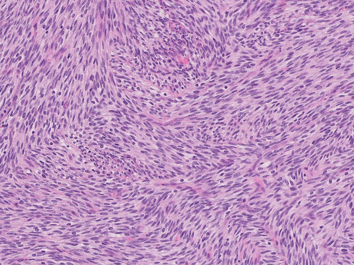 DrCycloPath's tweet image. #PathQuiz 🔬🦵 #SoftTissuePath

A) Solitary Fibrous Tumor
B) Malignant Peripheral Nerve Sheath Tumor
C) Adult Fibrosarcoma
D) Synovial Sarcoma

#Pathology #SoftTissuePath #Sarcoma