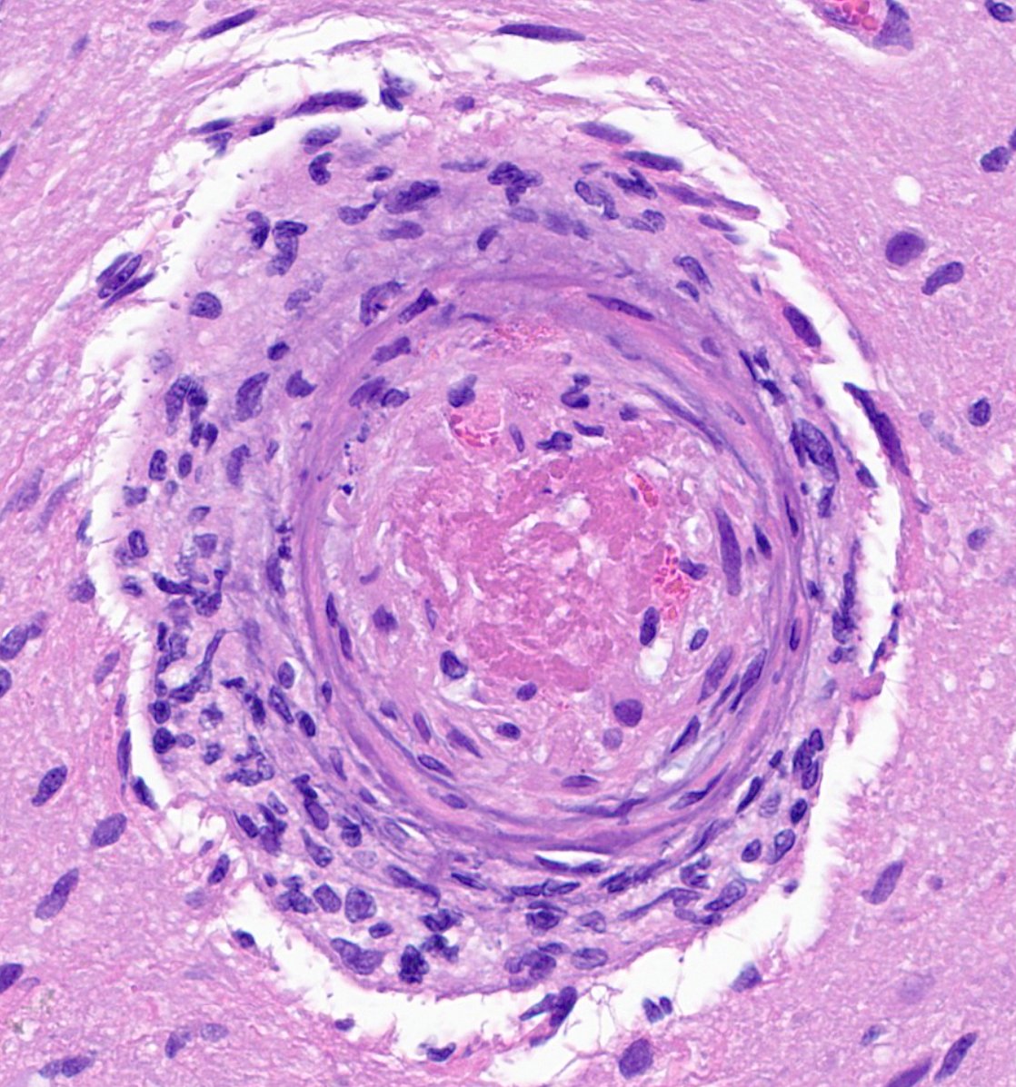 CraigHorbinski's tweet image. Intravascular thrombus surrounded by secondary structuring of #glioblastoma cells. #pathology #neuropath #pathtwitter