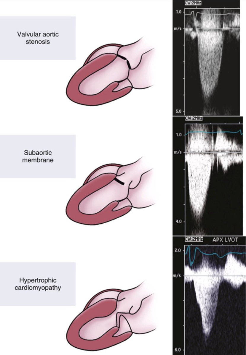 ZainKhalpey's tweet image. Not all LVOT obstruction is the same. 

Doppler shape can help differentiate valvular, subvalvular, and dynamic causes beyond just peak velocity.

@TrackYourHeart 

#MedTwitter #Cardiology #Echocardiography #CardiacImaging