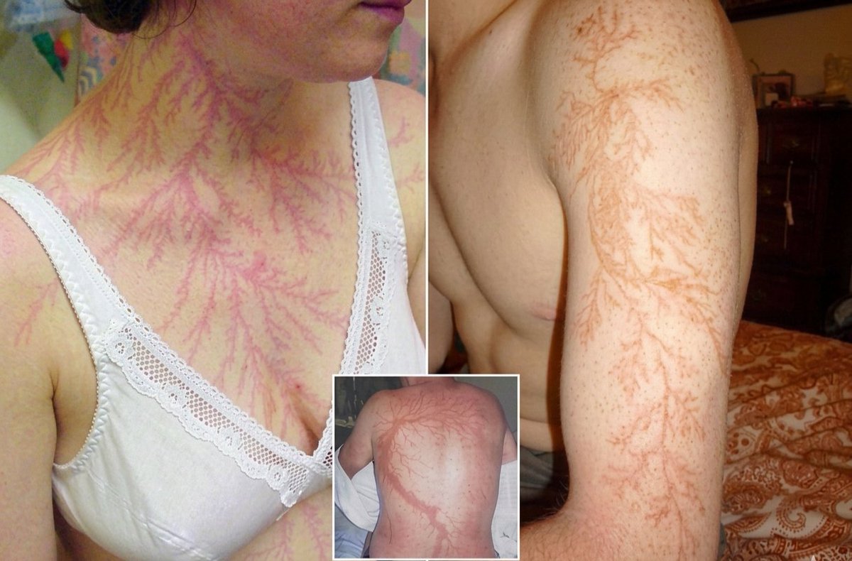suhail_nasim's tweet image. Can you name this striking pattern caused by a lightning strike? ⚡
#MedicalEducation #EmergencyMedicine