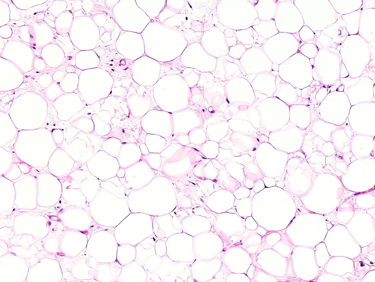 DrCycloPath's tweet image. #PathQuiz 🔬🥩 #SoftTissuePath

A) Lipoma
B) Spindle Cell Lipoma
C) Myxoid Liposarcoma
D) Atypical Lipomatous Tumor

#Pathology
