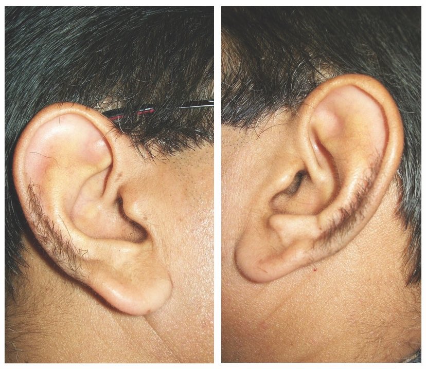 What is really the function of the hair on the pinna?