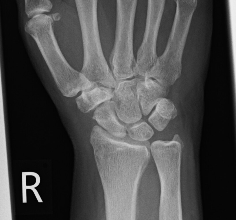 HanChong90's tweet photo. Despite being the second common site for carpal OA, STTJ arthritis is often overshadowed. 
We aim to map global practice in diagnosis, non-operative care, and surgical treatment of isolated and combined STTJ arthritis.
Link to the 5-minute survey in the first reply below!👇 https://t.co/02CxqI2lsh