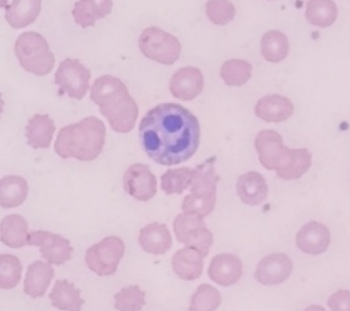 kalishahillmd's tweet photo. One of my peripheral blood smears today sensed my joy for PLS and smiled at me. See you all soon! #PLS26 #HOD #HILLDAY @Pathologists https://t.co/pyRz8c5CVJ