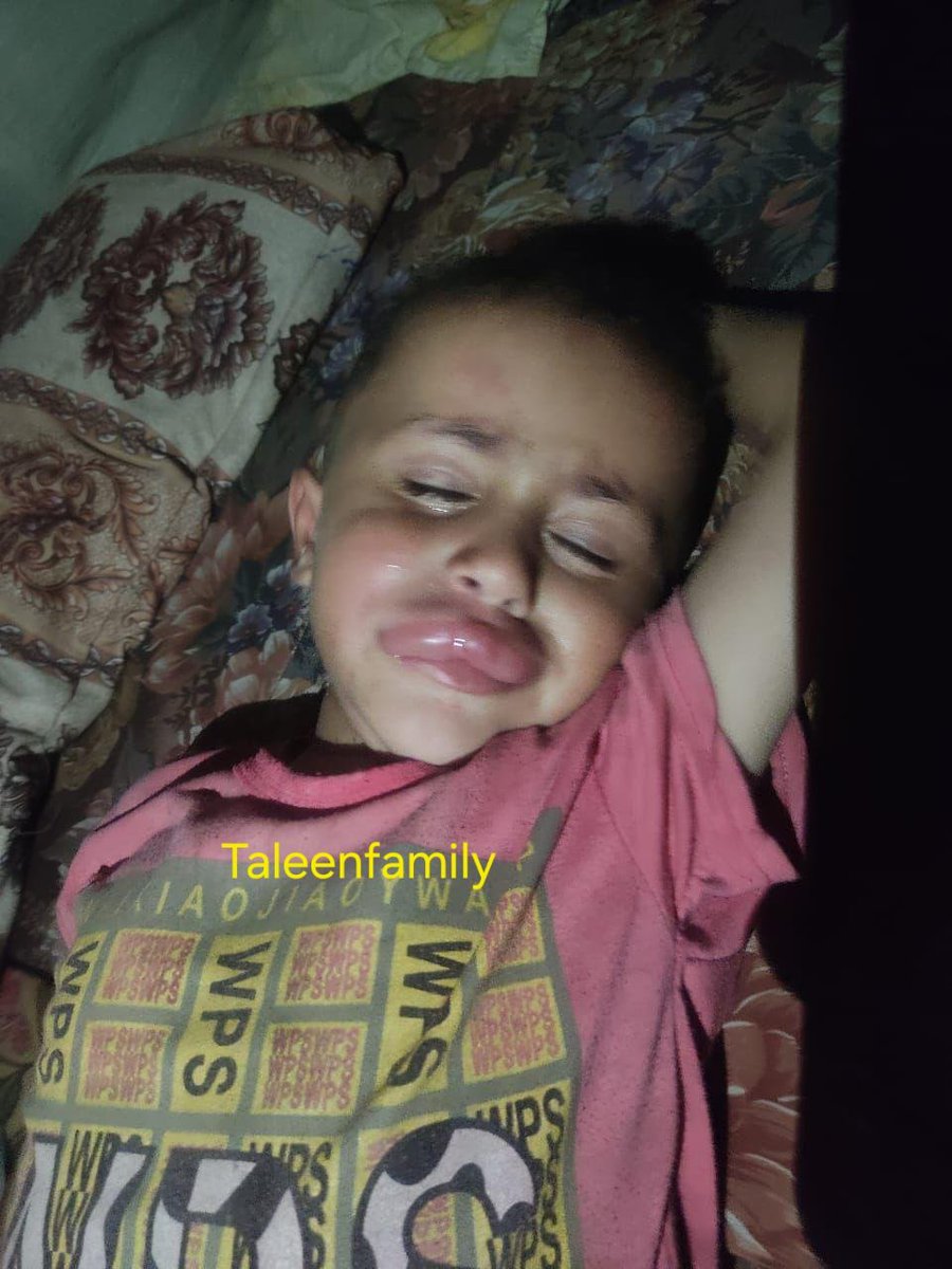 My little son suffers from crazy pain, he suffers from a "Rat bite" due to lack of shelter and cleanliness, we sit in a shelter full of flies, insects and garbage, our house is completely destroyed

5 replies — even dots — can save my son
chuffed.org/project/taleen