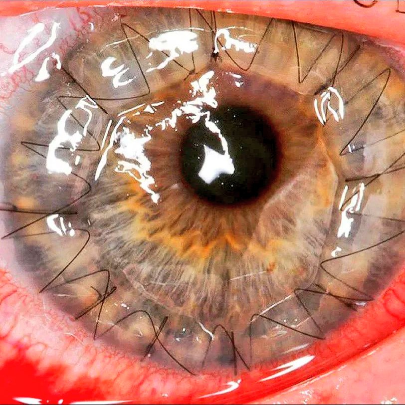 Spot the diagnosis: 
What’s been done to this eye?