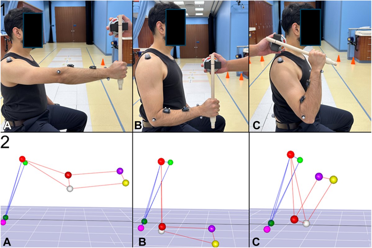 JHandSurg's tweet image. Can the function of pronator teres versus pronator quadratus be isolated by elbow positioning? Find out the answer in the April 2026 issue of JHS! 

jhandsurg.org/article/S0363-…

#JHS #dynamic #EMG #pronation #pronator #teres #quadratus