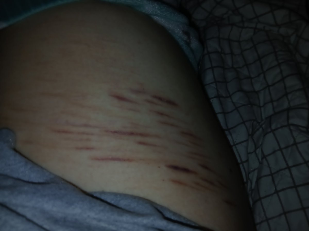 Does anyone know why my healed up cuts are deep purple today? They were pink like two days ago