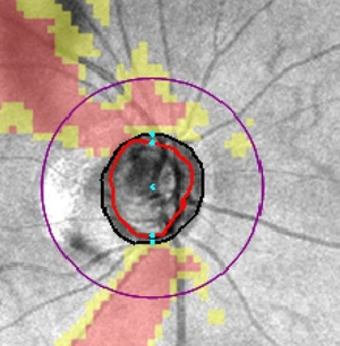 Ophthalmology tweet media